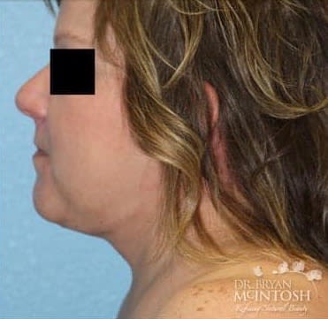 Neck Lift After, Female 47 - 3410