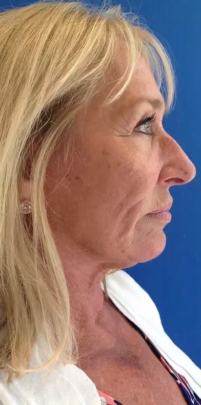 Neck Lift Before, Female 56 - 2838