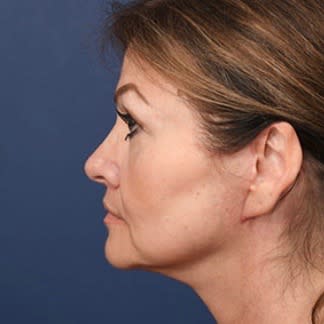 Neck Lift After, Female 58 - 1988