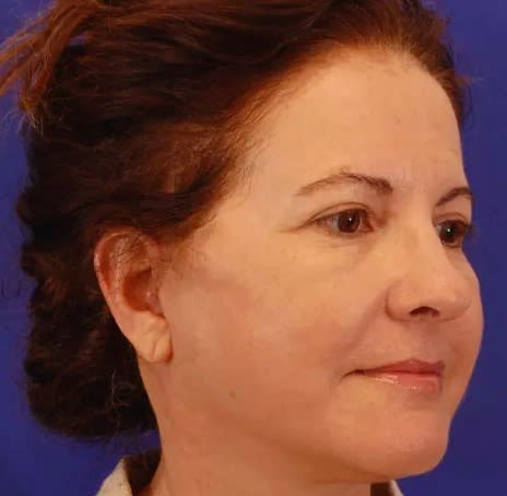 Facelift After, Female 52 - 2823