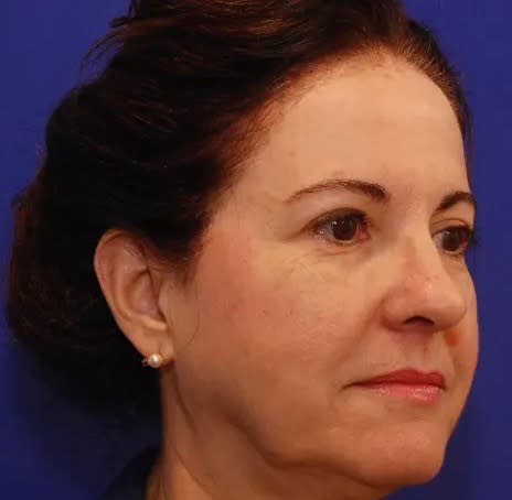 Facelift Before, Female 52 - 2823