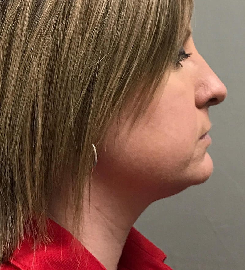 NeckTite™ After, Female 42 - 2677