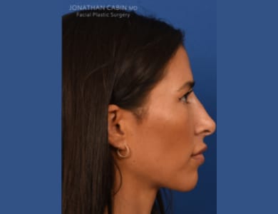 Liquid Rhinoplasty After, Female 34 - 1989