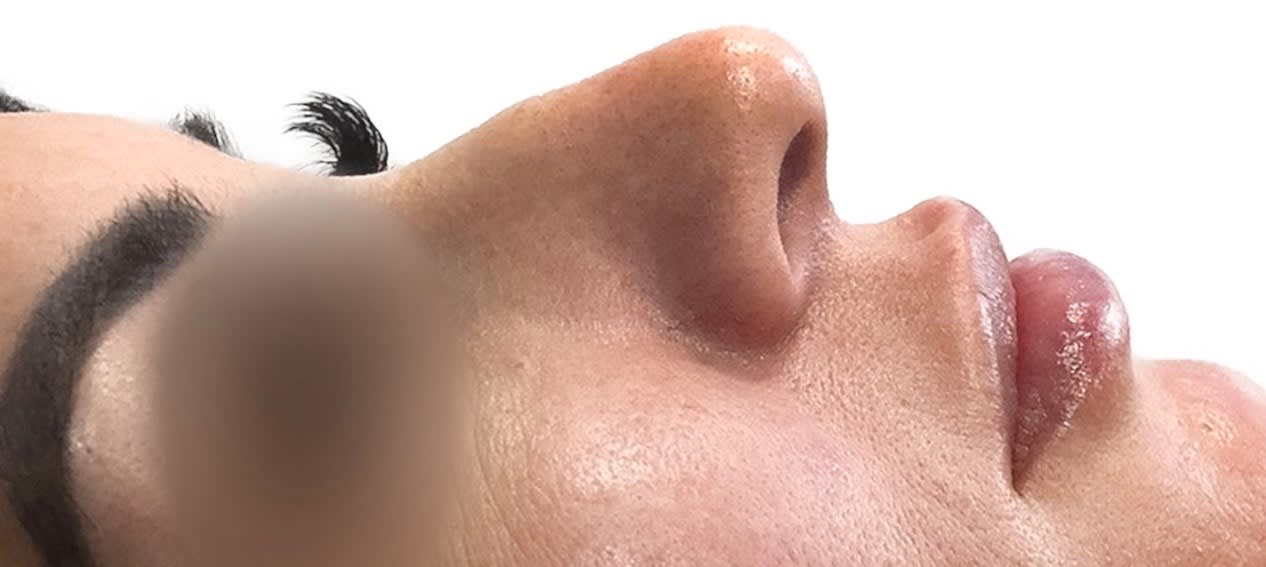 Liquid Rhinoplasty Before, Female 28 - 2321