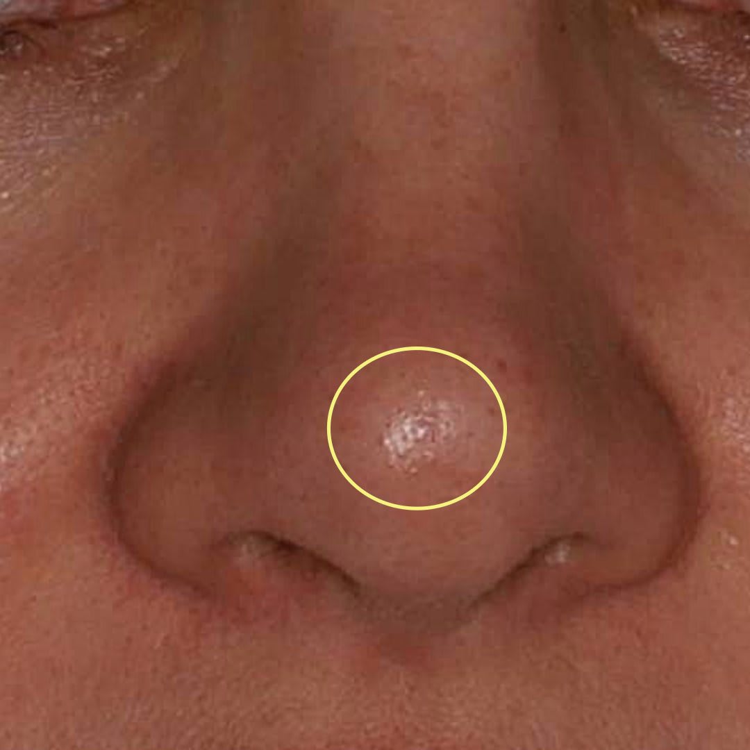 Birthmark, Mole, & Skin Growth Removal Solutions After, Female 34 - 4860