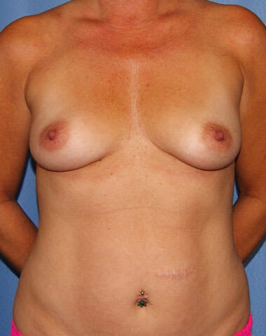 Breast Augmentation with Fat Transfer Before, Female 55 - 2523