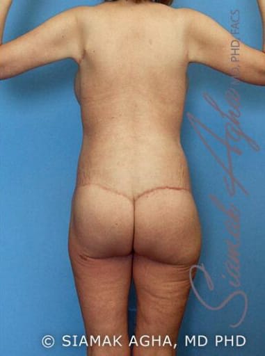 Body Contouring Solutions After, Female 43 - 2573