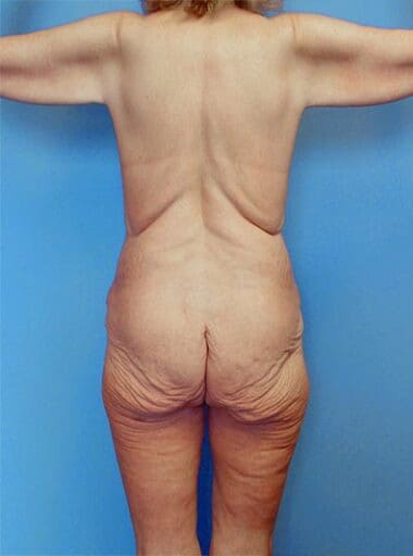 Body Contouring Solutions Before, Female 43 - 2573