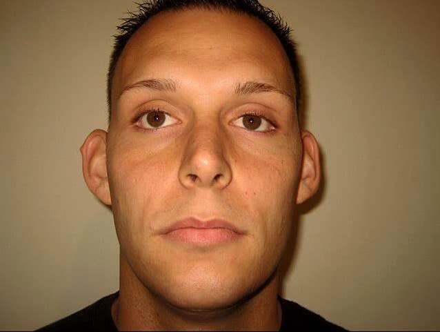 Ear Surgery (Otoplasty) Before, Male 31 - 2150