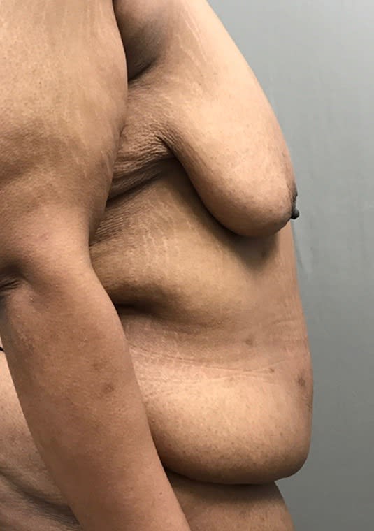 Panniculectomy Before, Female 44 - 2684