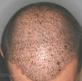 NeoGraft After, Male 43 - 2642