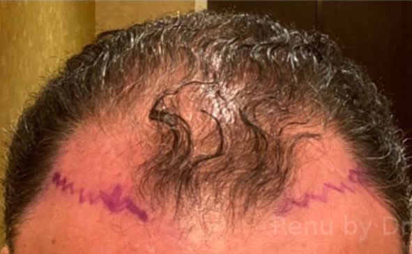 NeoGraft Before, Male 55 - 2654