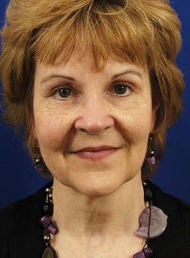 Endoscopic Brow Lift After, Female 70 - 1911