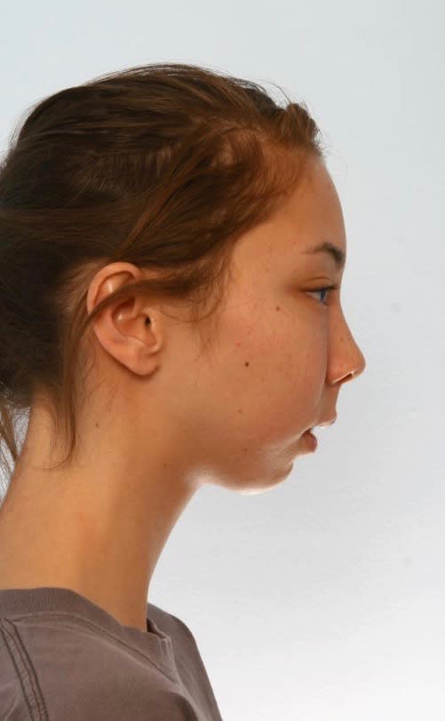 Osseous Genioplasty for Chin Deformity After, Female 18 - 1876