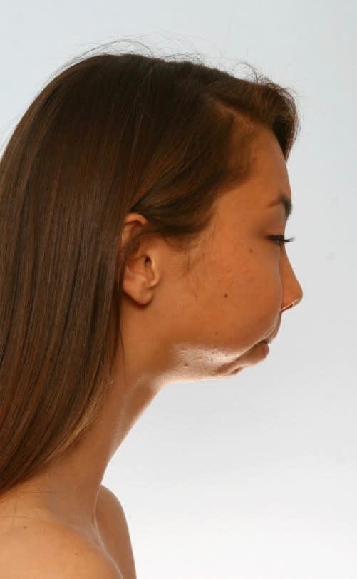 Osseous Genioplasty for Chin Deformity Before, Female 18 - 1876