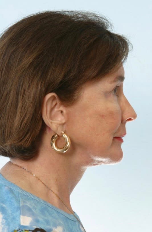 Chin Augmentation After, Female 76 - 1877