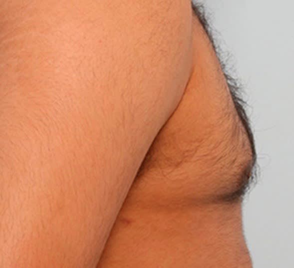 Male Breast Reduction Solutions After, Male 22 - 1880