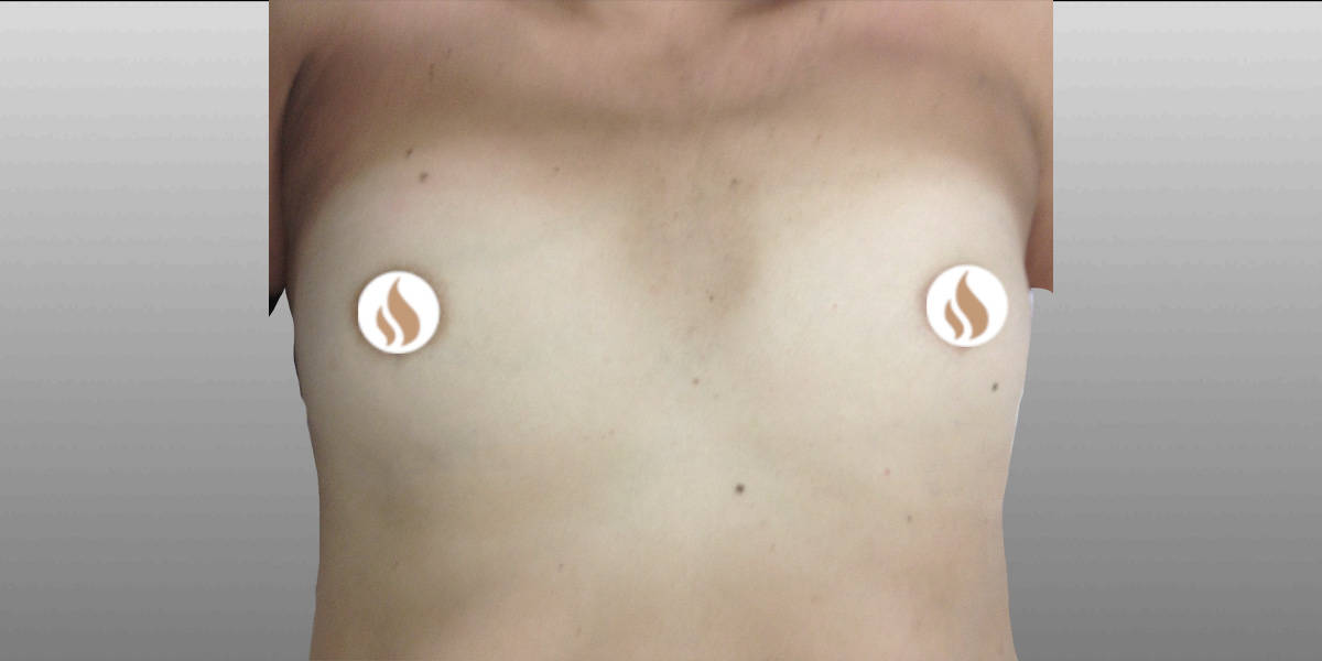 Breast Augmentation (Augmentation Mammaplasty) Before, Female 28 - 3923