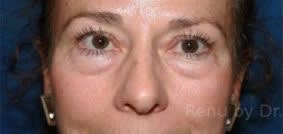 Blepharoplasty Before, Female 58 - 2643