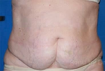 SlimLipo Before, Female 56 - 2705