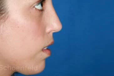 Chin Enhancement Solutions After, Female 21 - 2650