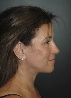 Facelift After, Female 52 - 4606