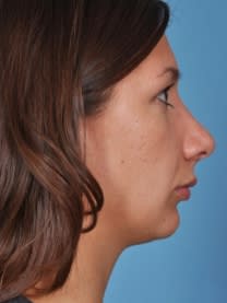 Rhinoplasty After, Female 23 - 4596