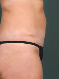 Tummy Tuck (Abdominoplasty) After, Female 38 - 4588