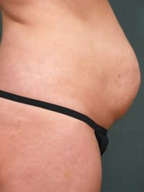 Tummy Tuck (Abdominoplasty) Before, Female 38 - 4588