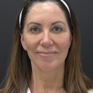 Laser Skin Resurfacing Before, Female 54 - 3988