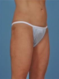 Liposuction After, Female 44 - 4590