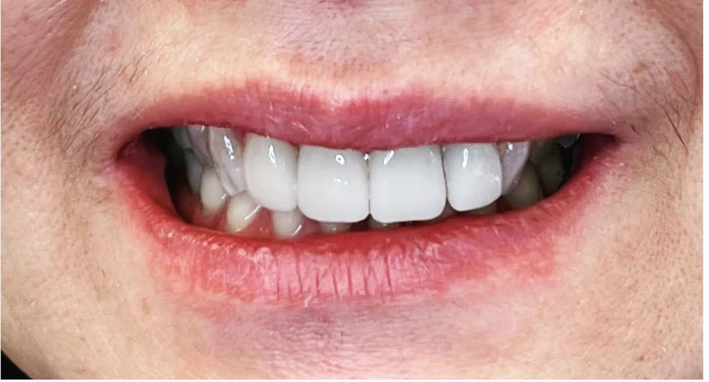 Dental Crowns After, Female 52 - 4014