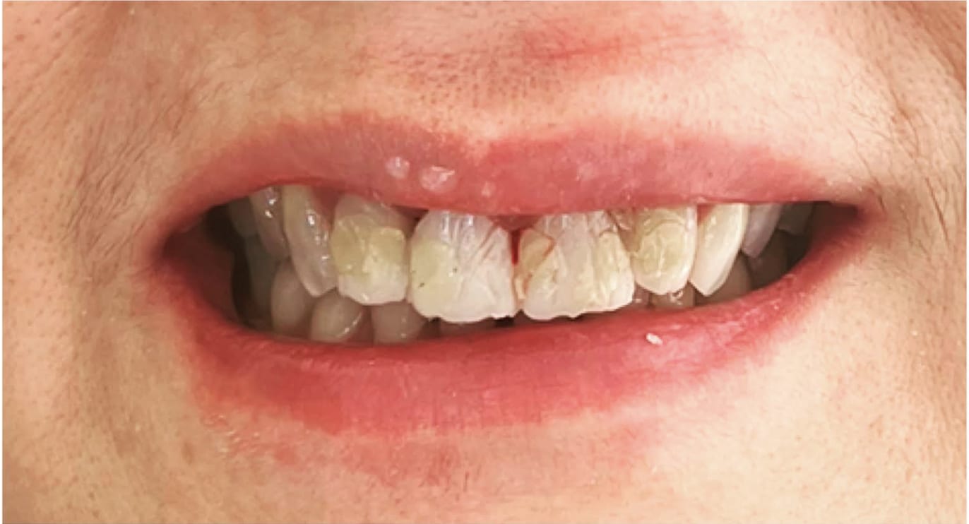 Dental Crowns Before, Female 52 - 4014