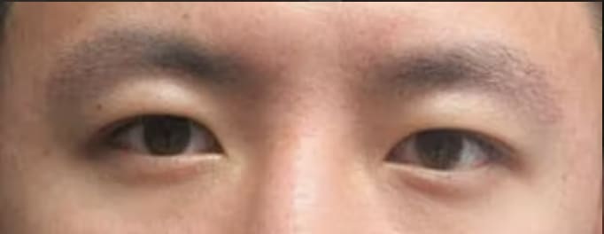Asian Blepharoplasty Before, Male 35 - 3032