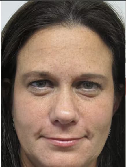 Brow Lift Before, Female 34 - 3023