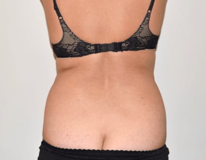Radiofrequency-Assisted Liposuction (RFAL) Before, Female 45 - 198