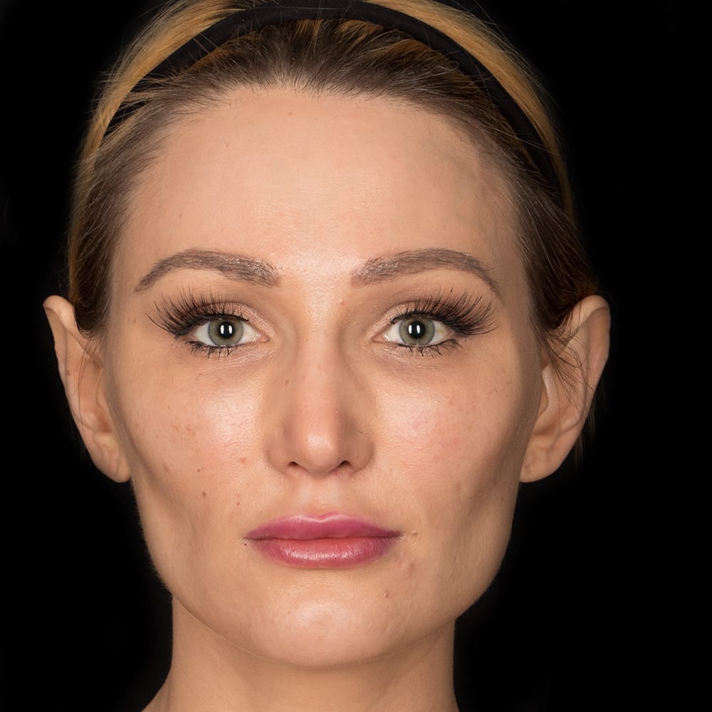 Dermal Fillers & Injectables Before, Female 25 - 94