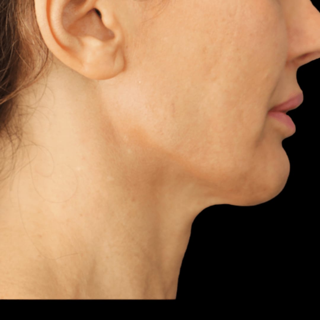 Microneedling with Radiofrequency (RF) Before, Female 39 - 919