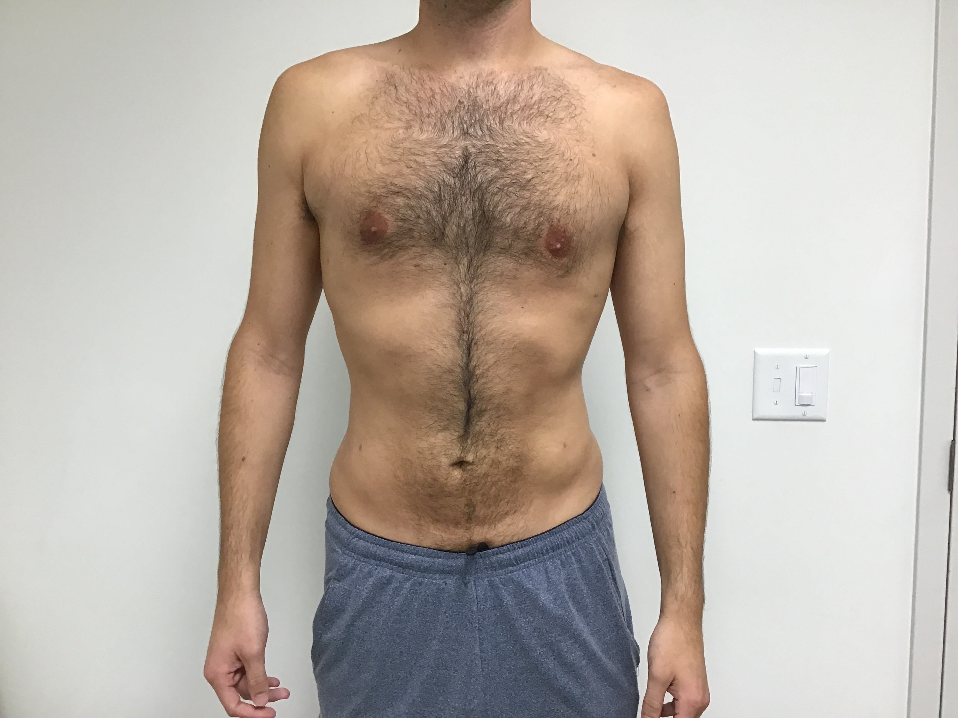 Liposuction After, Male 38 - 2046