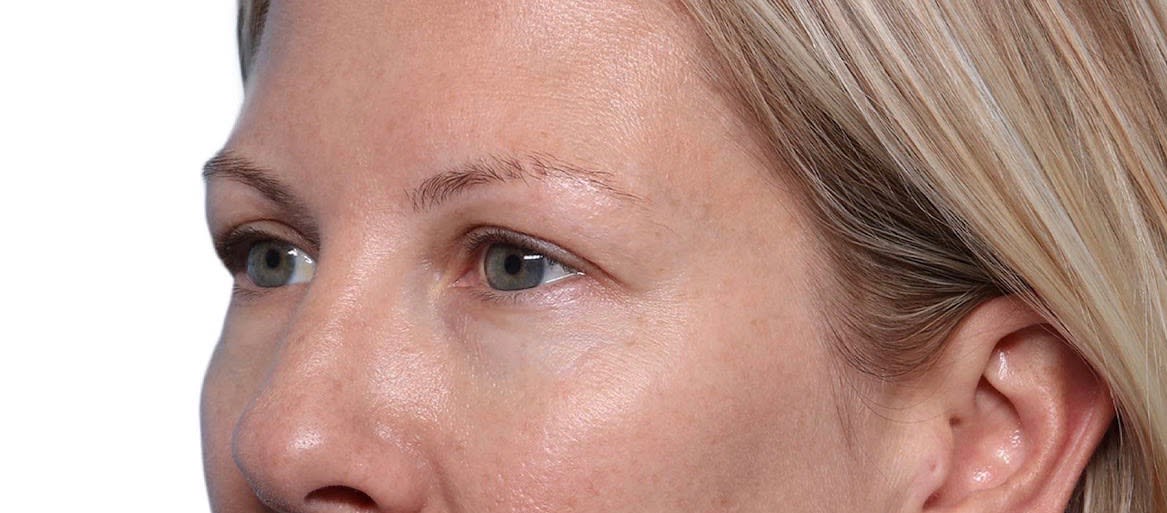 Blepharoplasty Before, Female 50 - 2322