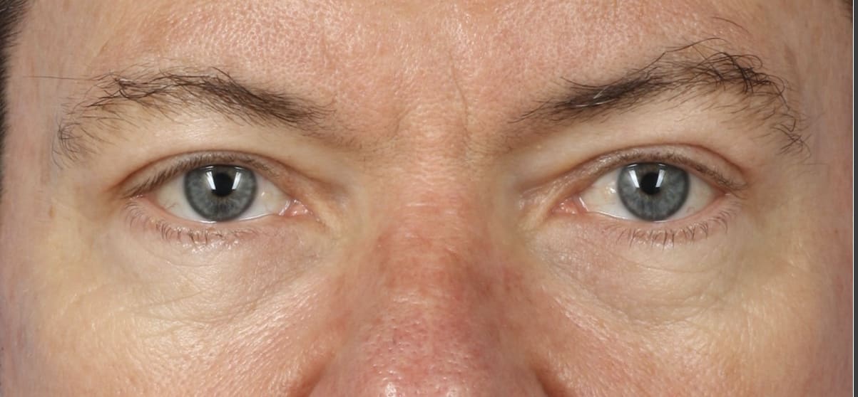 Blepharoplasty After, Male 51 - 125