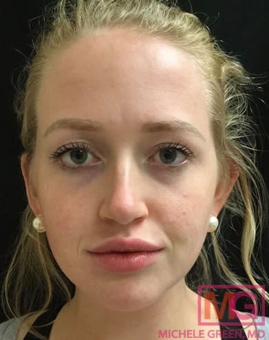 Restylane® After, Female 24 - 2175