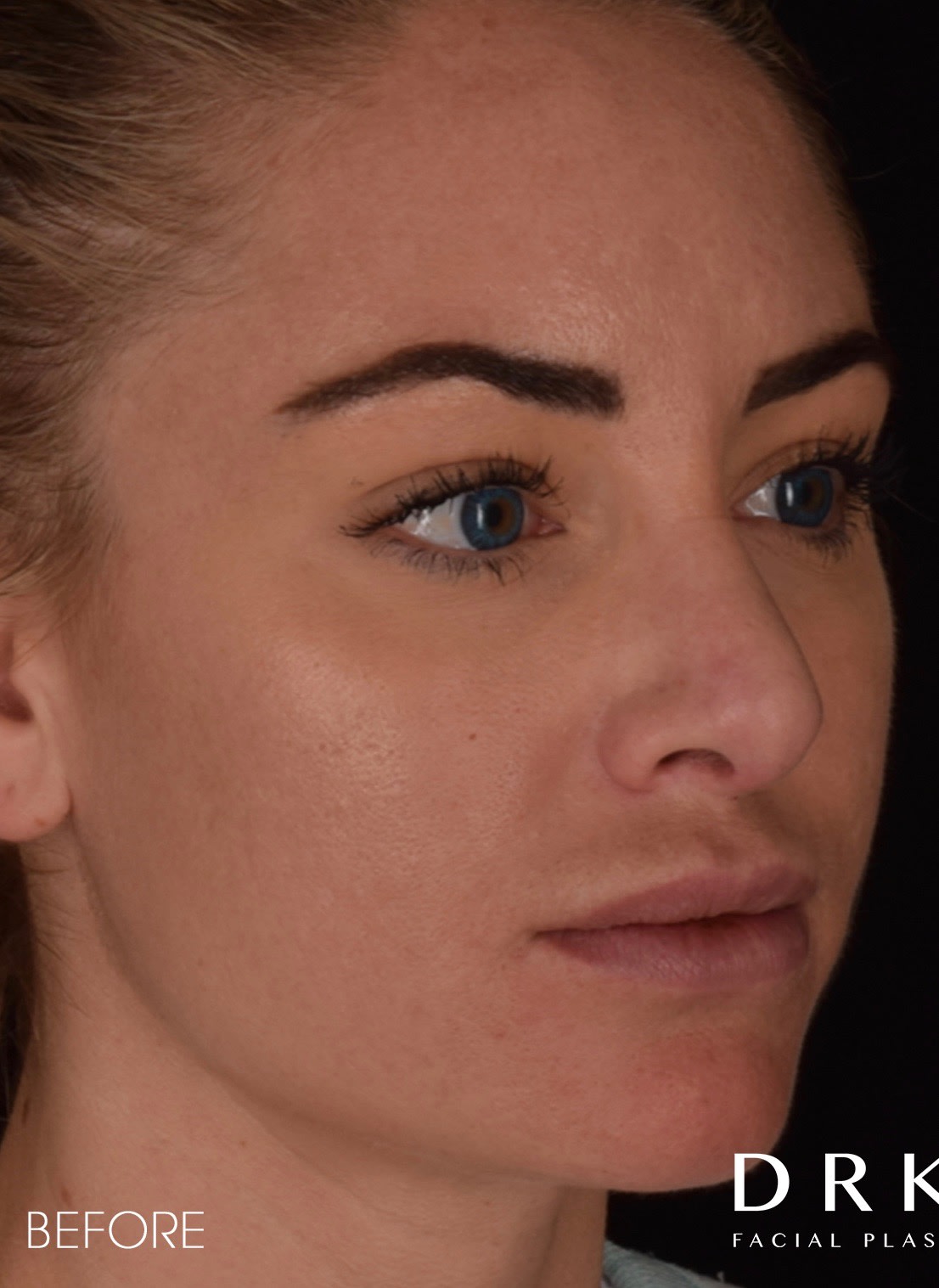 Revision Rhinoplasty Before, Female 29 - 3161