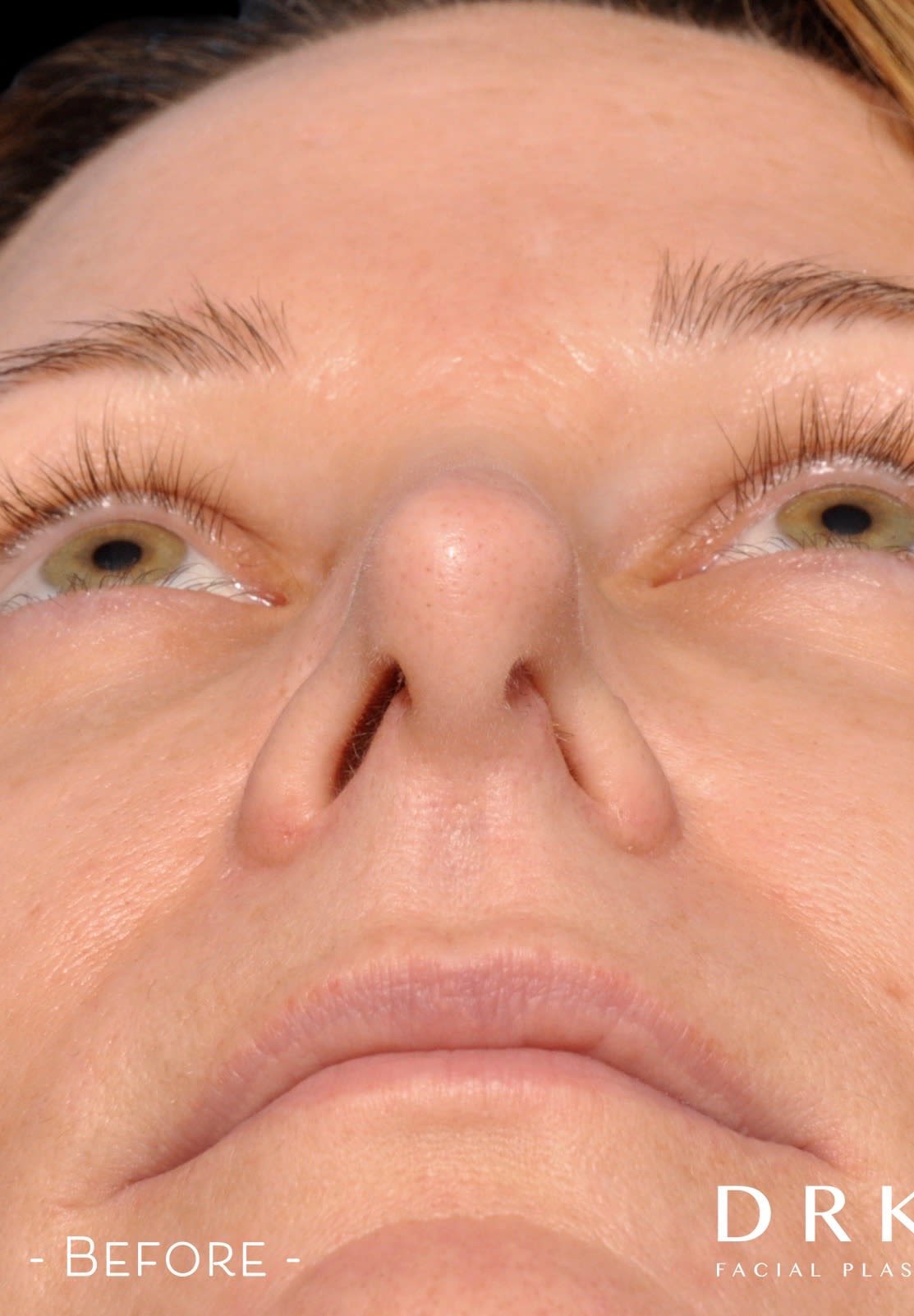 Closed Rhinoplasty Before, Female 50 - 3154