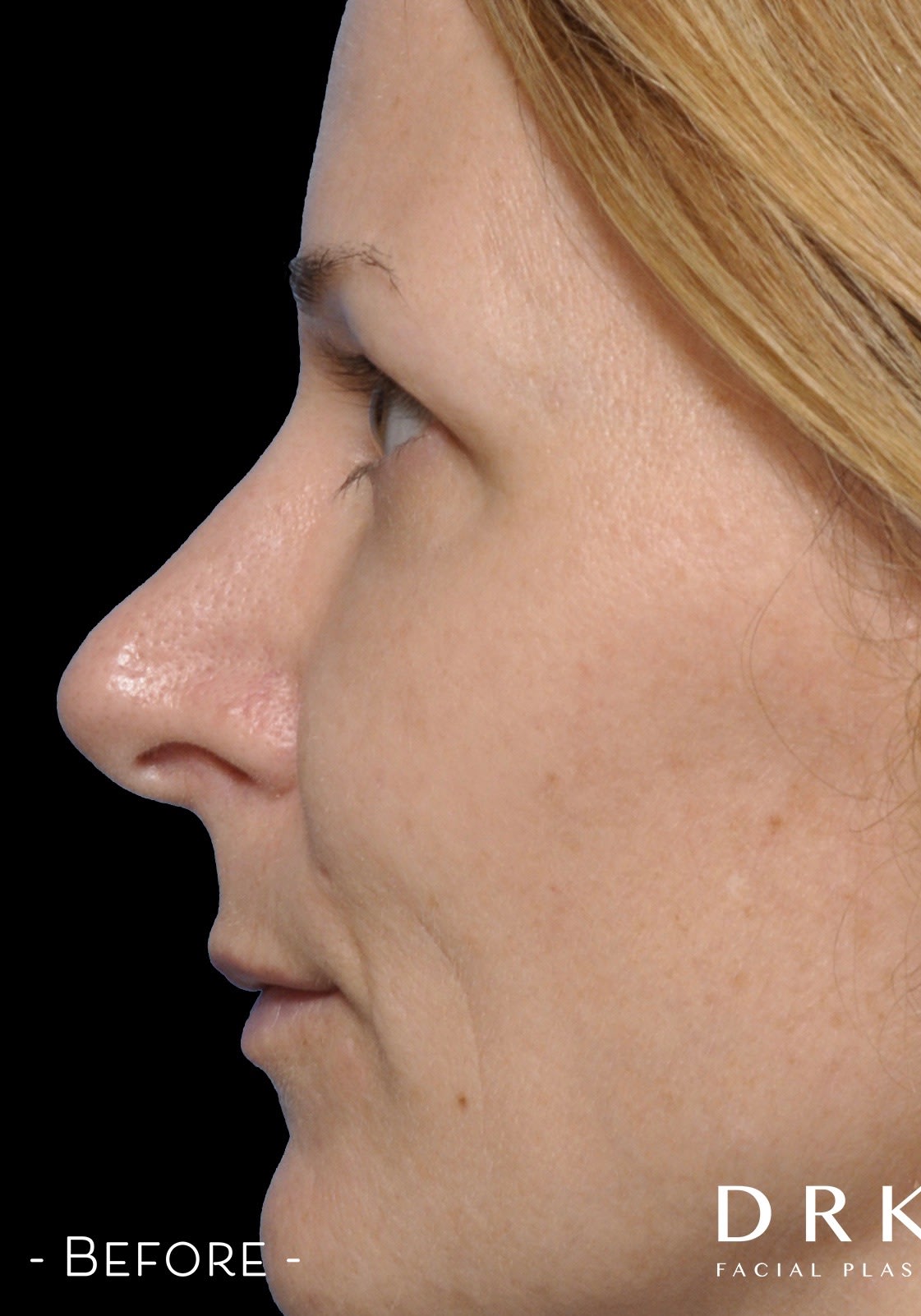 Closed Rhinoplasty Before, Female 50 - 3155