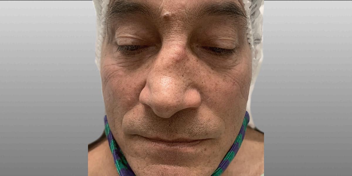 Rhinoplasty Before, Male 55 - 3947