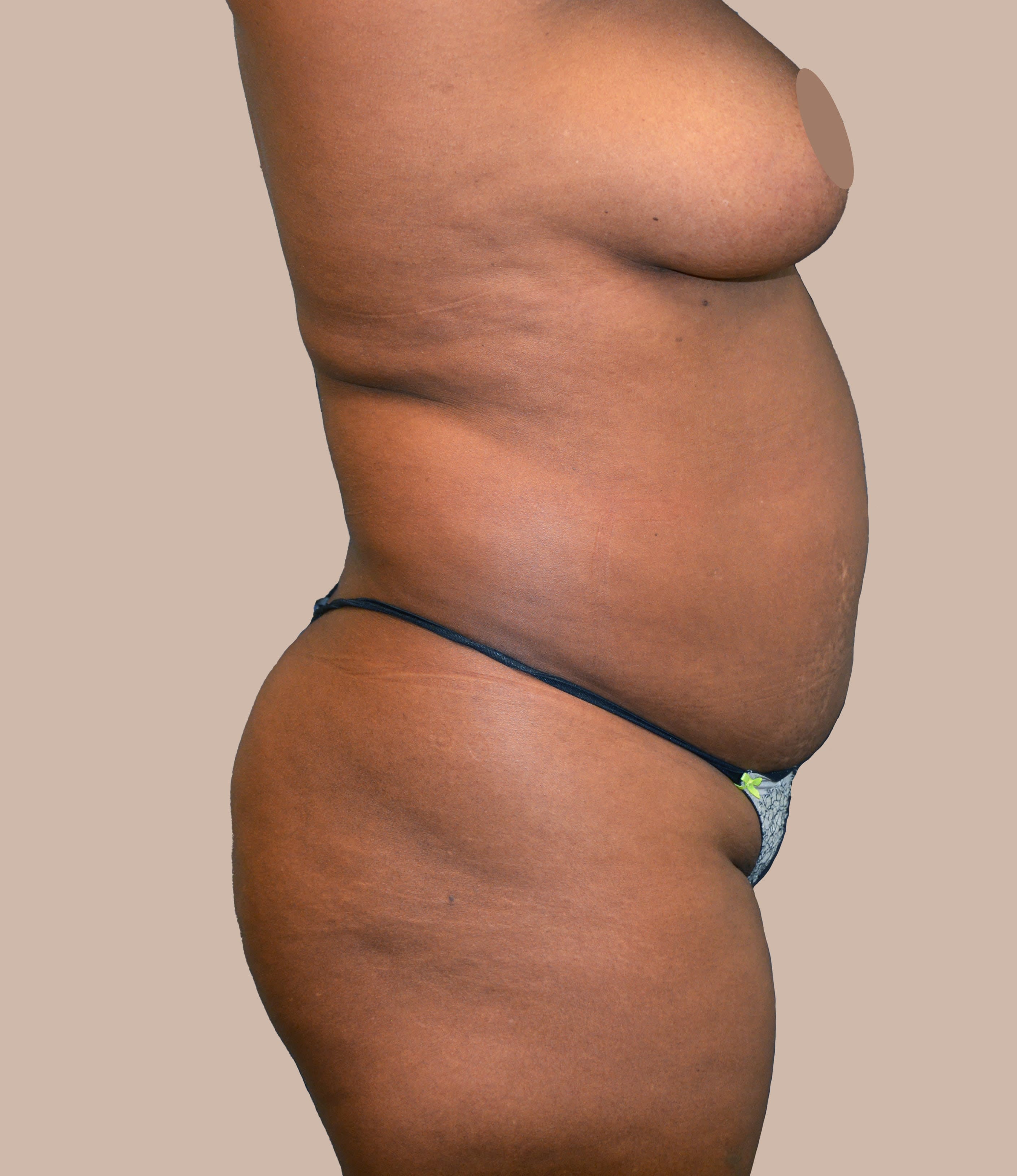Liposuction Before, Female 35 - 1170