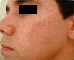 Acne Treatment After, Male 30 - 4294