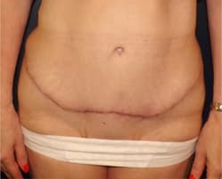 Tummy Tuck (Abdominoplasty) After, Female 43 - 4293