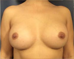 Breast Augmentation (Augmentation Mammaplasty) After, Female 27 - 4297
